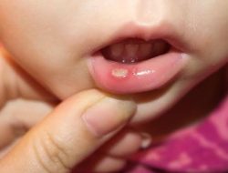 Obat Sariawan Anak, Baik Yang Alami Maupun Dengan Resep Dokter